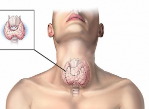 Ung thư tuyến giáp có chữa được không? Tìm hiểu ngay kẻo muộn