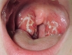 7 dấu hiệu cảnh báo ung thư vòm họng tuyệt đối không được chủ quan