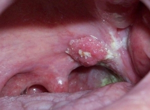 Ung thư vòm họng có lấy không? Lây qua những đường nào?