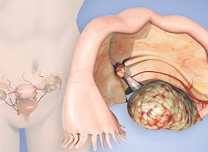 Nhận biết sớm các dấu hiệu ung thư phụ khoa trước khi quá muộn