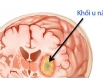 Khi nào đau đầu là triệu chứng khối u não?