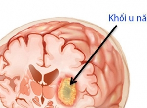 Khi nào đau đầu là triệu chứng khối u não?
