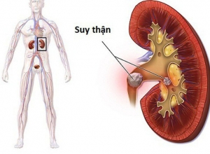 Bệnh suy thận: Nguyên nhân là gì? Biến chứng như nào?