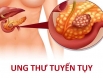 Nguyên nhân nào gây ung thư tuyến tụy? Đọc ngay kẻo muộn