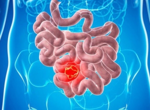 Ung thư ruột non: Khi nào bạn cần gặp bác sĩ?