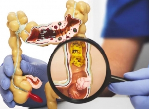 Gợi ý 4 phương pháp điều trị ung thư trực tràng, có thể bạn chưa biết