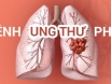 Tại sao không hút thuốc mà vẫn bị ung thư phổi?