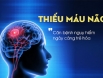 Dấu hiệu nhận biết bệnh thiếu máu não, liệu bạn đang có các triệu chứng này?