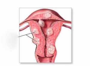 Những yếu tố nào làm tăng nguy cơ bị ung thư âm hộ?