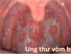 Cảnh báo các yếu tố tiềm ẩn có thể gây ung thư vòm họng