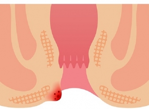 Bỏ túi ngay 10 cách chữa triệt để bệnh trĩ tại nhà
