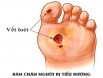 Dấu hiệu bất thường ở bàn chân cảnh báo người tiểu đường cần đến bệnh viện ngay