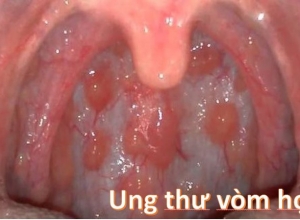 Ung thư vòm họng: Làm sao để chữa khỏi?