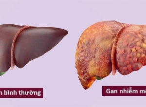 Đi khám ngay nếu có 5 dấu hiệu gan nhiễm mỡ dưới đây