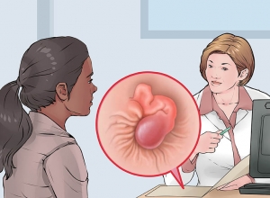 14 cách giúp co búi trĩ hiệu quả không phải ai cũng biết