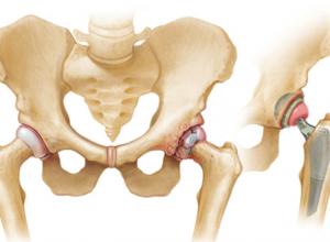 Cách phục hồi chức năng cho người bệnh sau phẫu thuật thay khớp háng