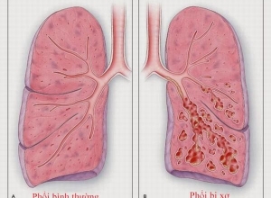 Bệnh xơ phổi có chữa được không? TÌm hiểu ngay trước khi quá muộn