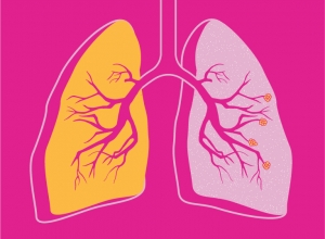 Cảnh báo: Biến chứng nguy hiểm của bệnh viêm phổi , có thể bạn chưa biết