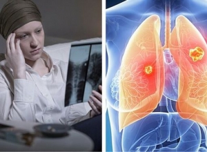 Vì sao phụ nữ mắc ung thư phổi ngày càng nhiều hơn?