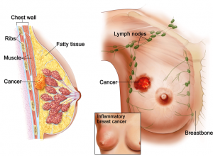 Ung thư vú ở nữ giới: Hãy ngăn ngừa trước khi quá muộn