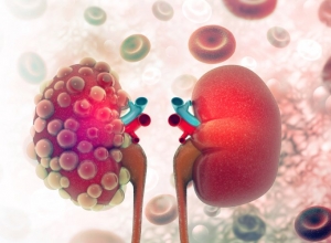 Kim tiền thảo chữa sỏi thận? Tin được không? Tìm hiểu ngay để biết