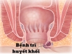 Trĩ huyết khối và những điều không phải ai cũng biết về bệnh trĩ