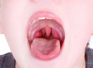 6 dấu hiệu của ung thư vòm họng giai đoạn đầu  