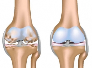 Lá lốt chữa đau xương khớp? Liệu có đúng như lời đồn?
