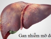 Gan nhiễm mỡ độ 2 có chữa khỏi được không?