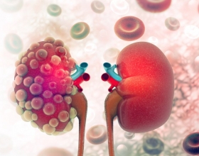 Ai có nguy cơ mắc sỏi thận? Làm cách nào để phòng tránh sỏi thận?