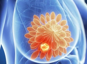 Sau mổ ung thư vú nên ăn gì để tránh tái phát? Tìm hiểu ngay để biết 