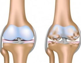 Mẹo dân gian chữa thoát vị đĩa đệm bằng ngải cứu