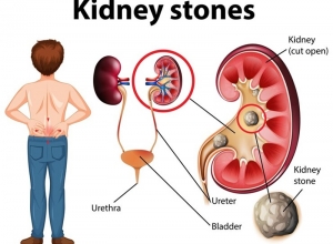 Đang viêm đường tiết niệu có nên sinh hoạt tình dục?