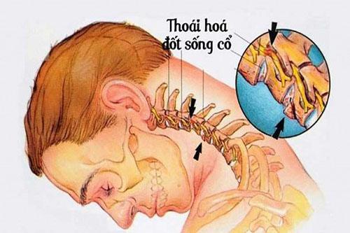 Thoái hóa cột sống cổ