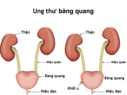 Ung thư bàng quang là nguyên nhân dẫn đến đi tiểu nhiều