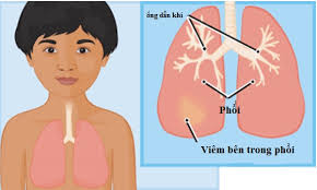 Cách điều trị và chăm sóc trẻ nhỏ bị viêm phổi đúng cách