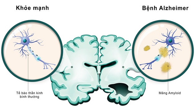 Bệnh Alzheimer có di truyền không? Tổng quan về bệnh Alzheimer