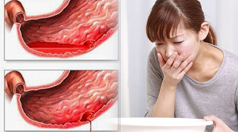 Xuất huyết dạ dày do đâu? 10 nguyên nhân gây xuất huyết dạ dày