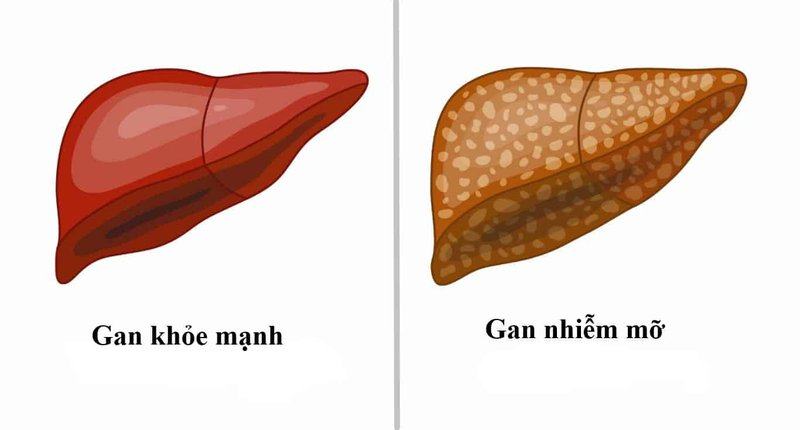 Uống rượu bia ảnh hưởng đến gan như thế nào?