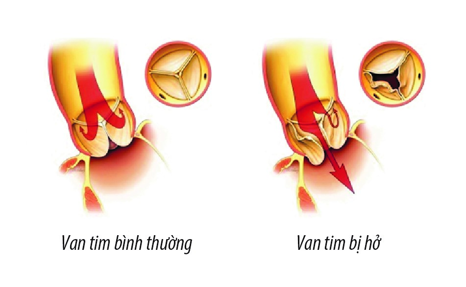 Những triệu chứng của bệnh hở van tim và cách điều trị hiệu quả