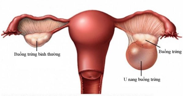 U nang buồng trứng có mang thai được không?
