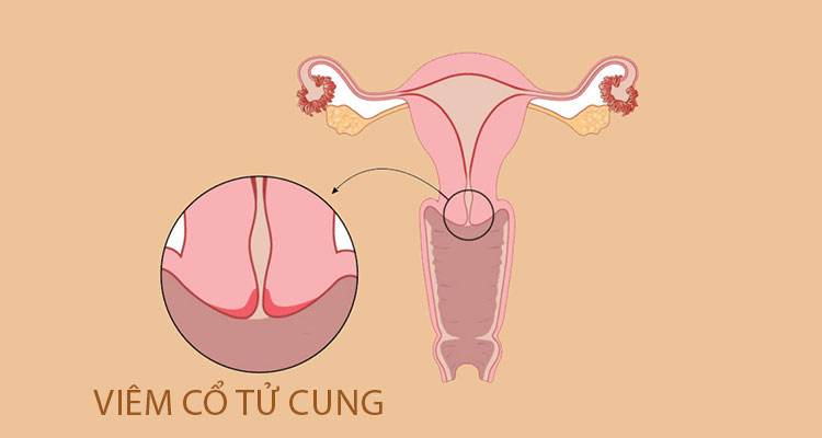 Dấu hiệu cảnh báo bạn mắc bệnh viêm cổ tử cung