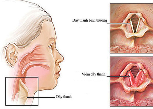 Cách chăm sóc trẻ bị viêm đường hô hấp cấp đúng cách tại nhà 