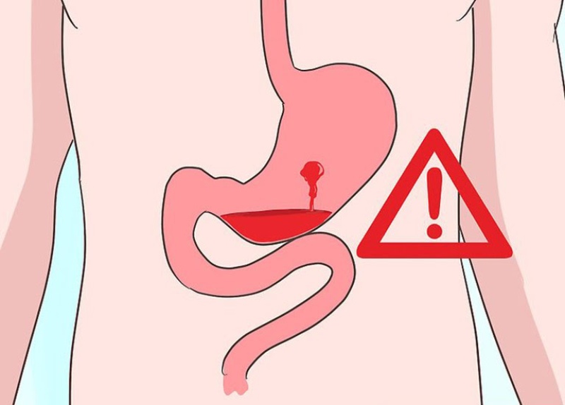 Xuất huyết dạ dày do đâu? 10 nguyên nhân gây xuất huyết dạ dày