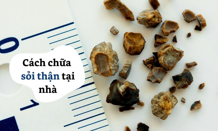 Top 18 cách Chữa Sỏi Thận Tại Nhà An Toàn, Hiệu Quả Cao