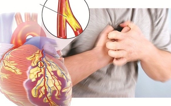 Mẹo dưới đây giúp bạn giảm những cơn đau thắt ngực hiệu quả