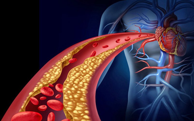 Mách bạn một số cách điều trị rối loạn lipid máu dễ dàng