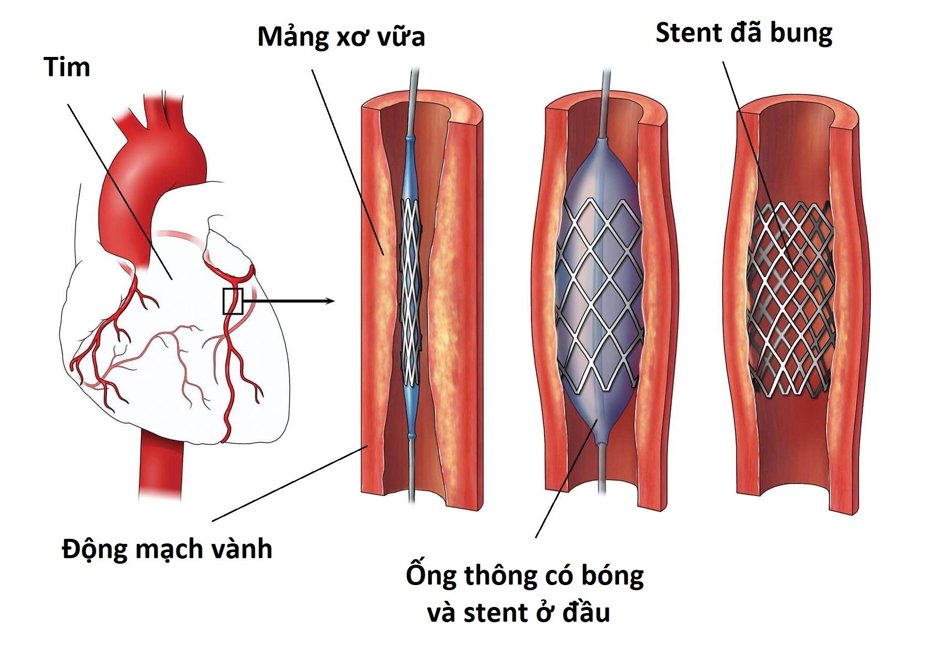 Mẹo dưới đây giúp bạn giảm những cơn đau thắt ngực hiệu quả