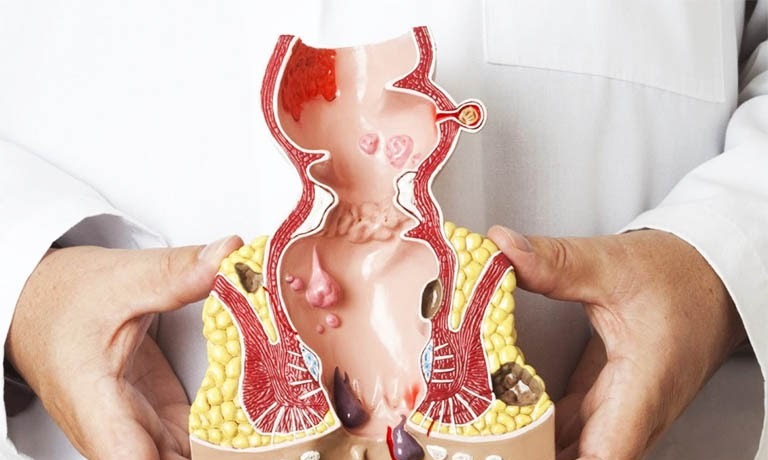 Các bài tập làm co búi trĩ hiệu quả nên áp dụng ngay