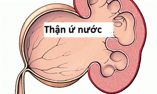 7 mẹo dân gian chữa thận ứ nước tại nhà hiệu quả
